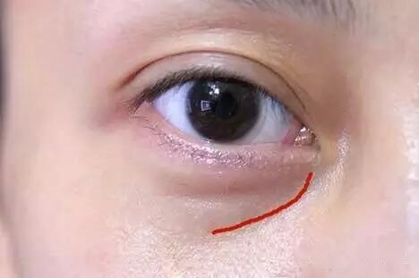 泪沟与眼袋有什么不一样