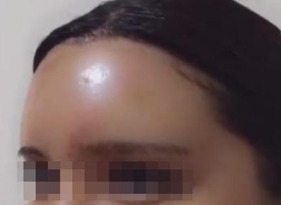 王东丰额头,额头填充,艺美整形,艺美王东整形