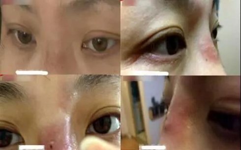 王东异物注射修复,艺美整形,整形修复