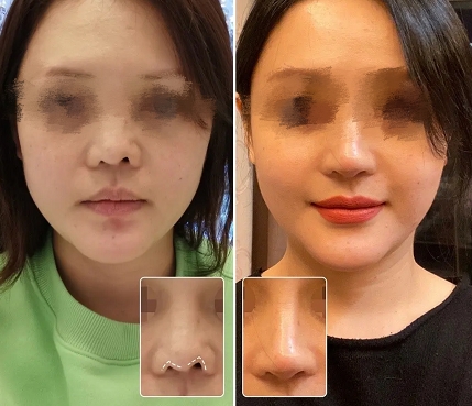 王东异物注射修复,艺美整形,整形修复