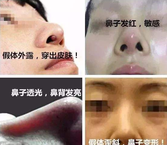 王东异物注射修复,艺美整形,整形修复
