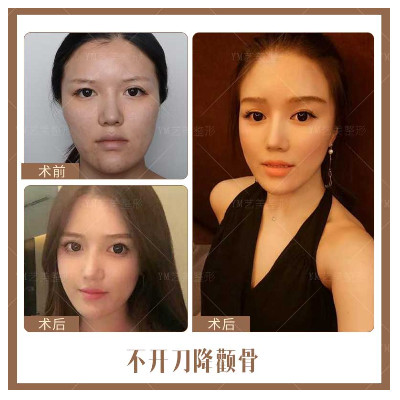北京做磨骨多少钱