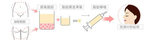 自体脂肪填充