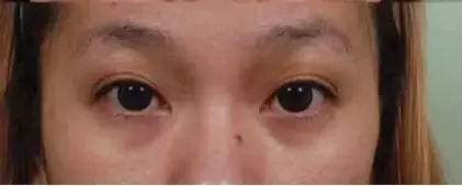 艺美王东：自体脂肪丰眼睑填术前与术后的注意事项可别忘了