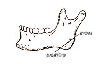 艺美王东告诉你下颌角宽大怎么改善