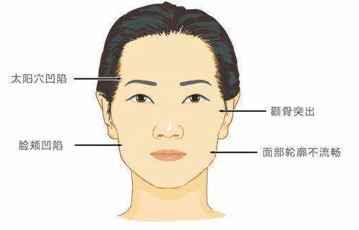 王东自体脂肪怎么样？主要可以填充哪些地方？