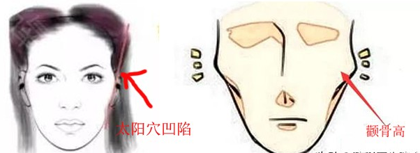 一针降颧骨