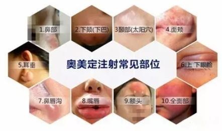 王东奥美定取出,北京奥美定取出,艺美奥美定取出
