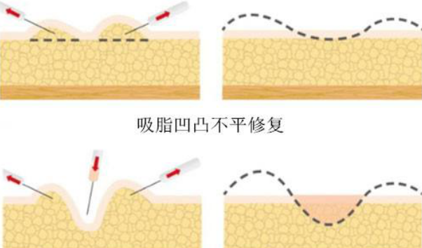 王东吸脂修复,王东吸脂凹凸不平修复,艺美王东吸脂修复