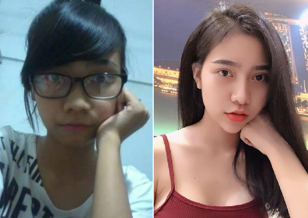 艺美面部整形,自体脂肪填充,北京艺美整形