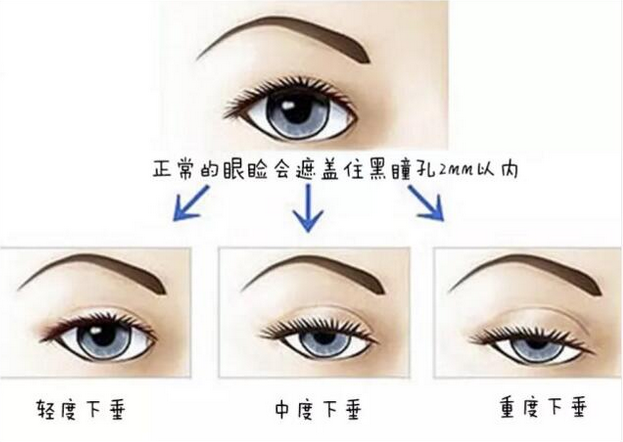 艺美面部整形,自体脂肪填充,北京艺美整形