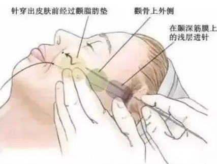 艺美巩敏面部精雕,巩敏面部填充,艺美整形巩敏