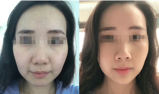 艺美巩敏面部精雕,巩敏面部填充,艺美整形巩敏