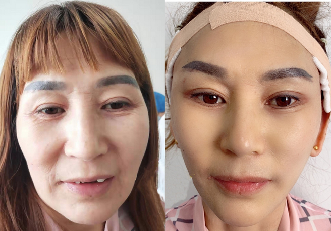 艺美巩敏面部精雕,巩敏面部填充,艺美整形巩敏