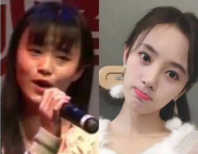 艺美巩敏面部精雕,巩敏面部填充,艺美整形巩敏