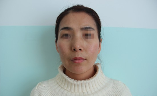 艺美巩敏面部精雕,巩敏面部填充,艺美整形巩敏