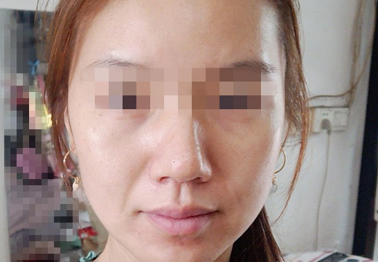 艺美巩敏面部精雕,巩敏面部填充,艺美整形巩敏