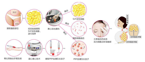 艺美巩敏面部精雕,巩敏面部填充,艺美整形巩敏