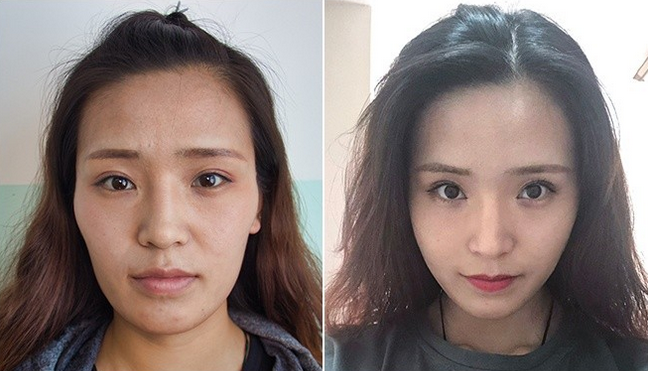 艺美巩敏面部精雕,巩敏面部填充,艺美整形巩敏