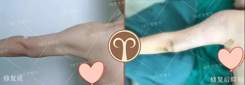 王东手臂吸脂失败修复前后对比