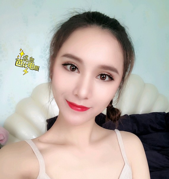 不开刀降颧骨案例