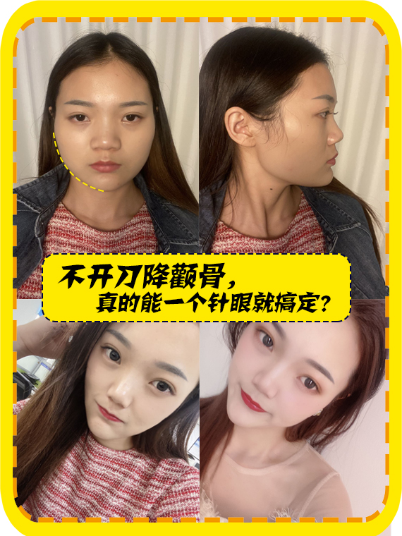 不开刀降颧骨，真的能一个针眼就搞定吗