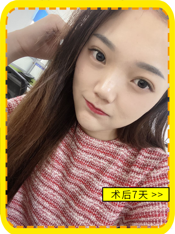 不开刀降颧骨术后7天