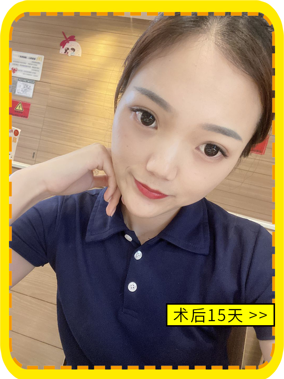 不开刀降颧骨术后15天