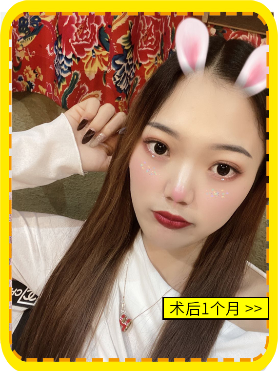 不开刀降颧骨术后一个月