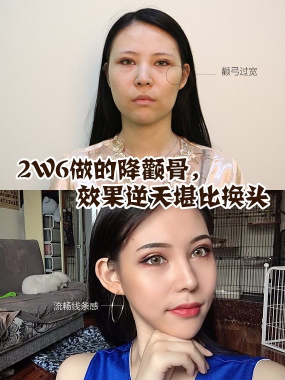 不开刀降颧骨