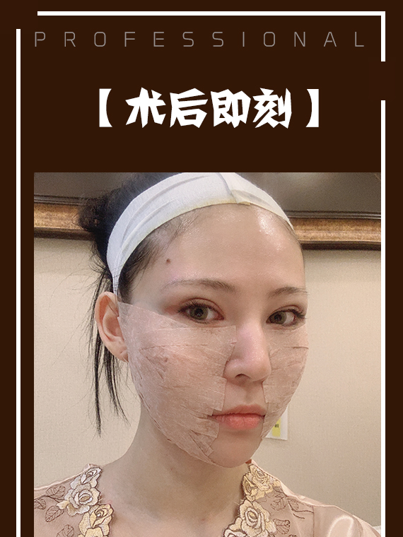 不开刀降颧骨术后即刻
