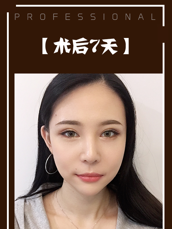 不开刀降颧骨术后7天