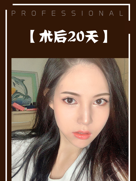 不开刀降颧骨术后20天