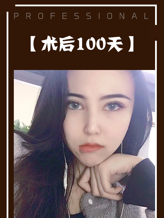 不开刀降颧骨术后100天