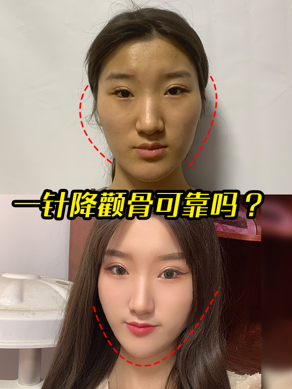 一针降颧骨可靠吗