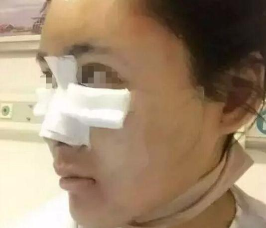 北京自体脂肪填充隆鼻多少钱？价格收费详情