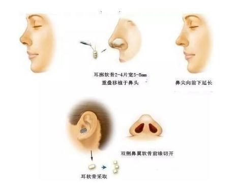 北京自体脂肪填充隆鼻多少钱？价格收费详情