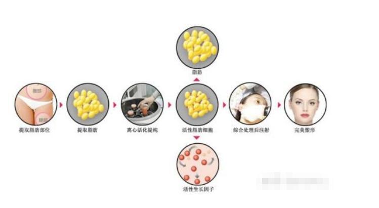 自体脂肪填充额头需要做二次填充吗？
