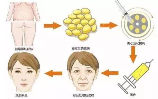 北京做自体脂肪丰面颊手术费用详情