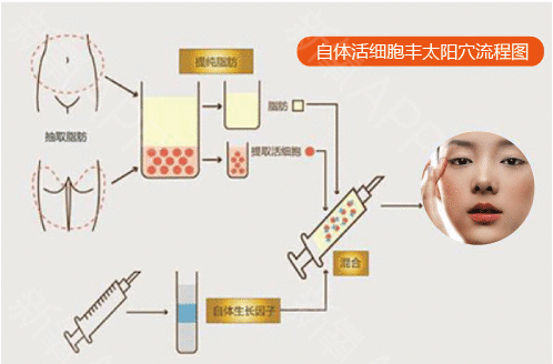 自体脂肪填充太阳穴后的感受 疼不疼