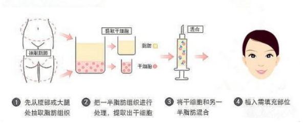 自体脂肪填充苹果肌可以维持多久
