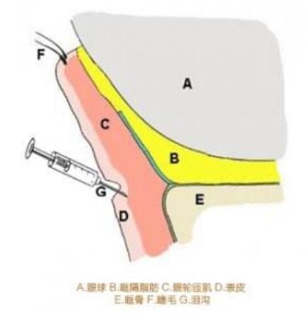 脂肪填充泪沟后多久恢复？自然效果何时呈现~