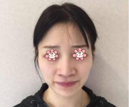 自体脂肪填充面颊终于恢复好了，附上我的照片！