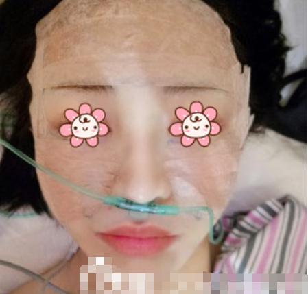 自体脂肪填充面颊终于恢复好了，附上我的照片！