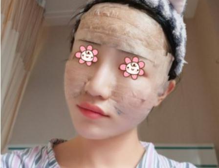 自体脂肪填充面颊终于恢复好了，附上我的照片！