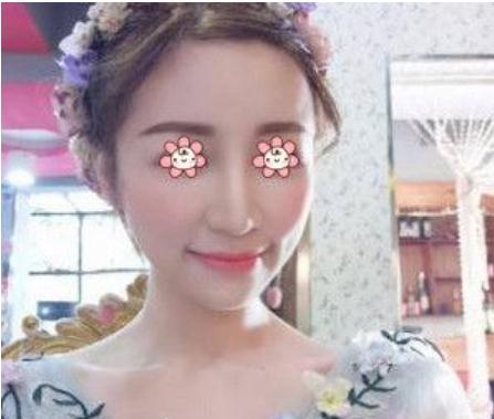 自体脂肪填充面颊终于恢复好了，附上我的照片！