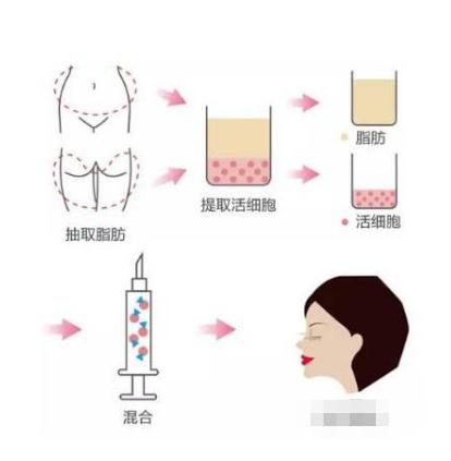 脂肪填充苹果肌好处 优点 优势