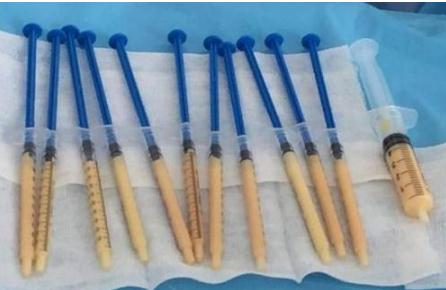 脂肪填充太阳穴抽烟会影响脂肪存活的效果吗？