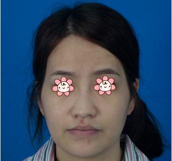 做了脂肪填充苹果肌，逆袭成心形脸女神！
