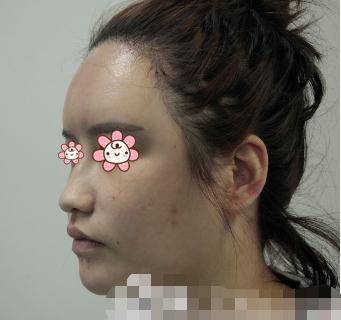 做了脂肪填充苹果肌，逆袭成心形脸女神！